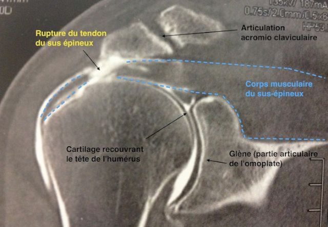 Vue frontale d'une rupture du sus-épineux à l'arthro-scanner