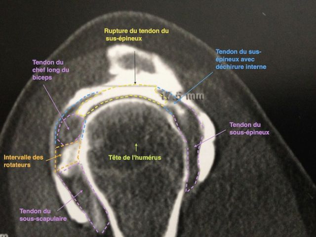 Vue sagitale d'une rupture du sus-épineux à l'arthro-scanner