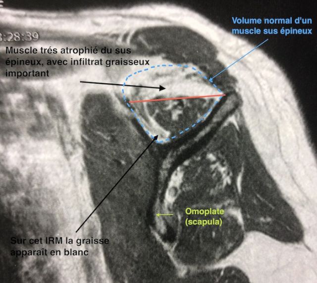Vue sagitale (de profil) des muscles de la coiffe pour évaluer la 
        fonte musculaire (amyotrophie) et l'infiltrat graisseux à l'IRM 
