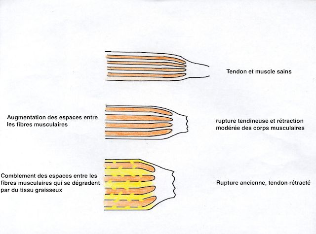Evolution des fibres musculaires après rupture 
        et comblement de la perte de volume par de la graisse