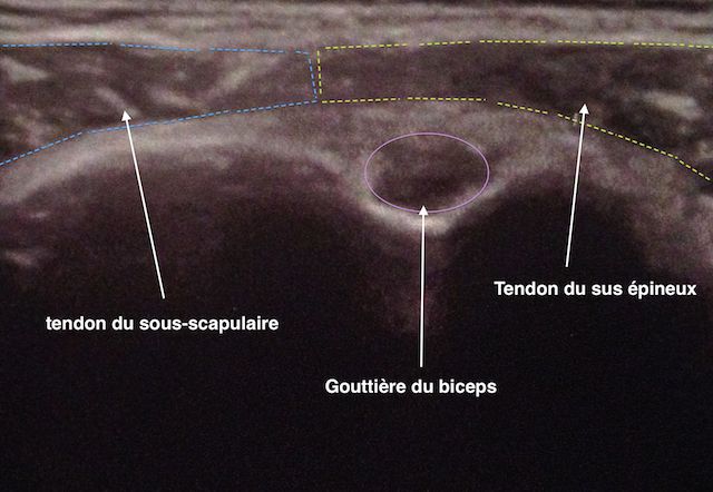 Echographie d'une tendinite du long-biceps