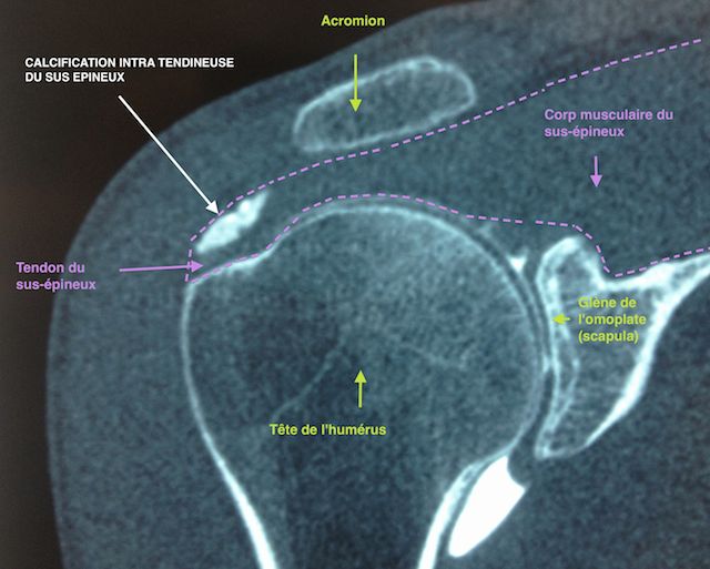 Calcification intra-tendineuse vue de face à l'arthroscanner