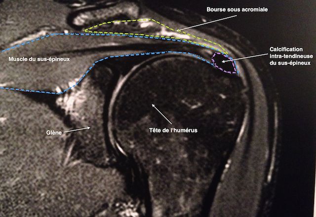 IRM d'une calcification du tendon du sus-épineux