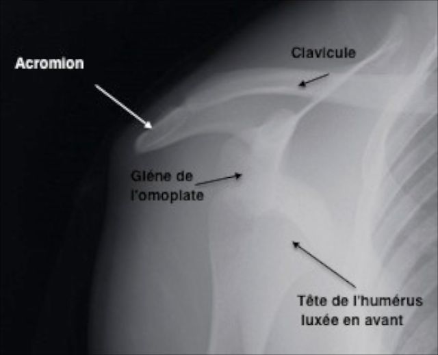 Radiographie de face d'une luxation antérieure d'épaule