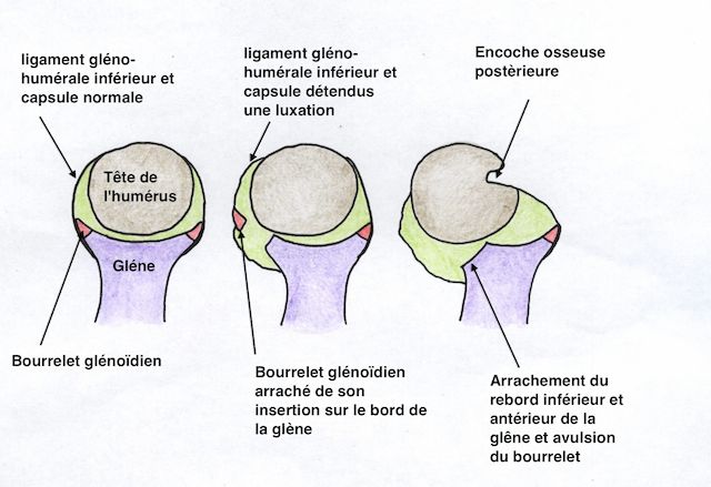 vue simplifiée des différentes lésions dans les instabilités 
                  antérieures de l'épaule