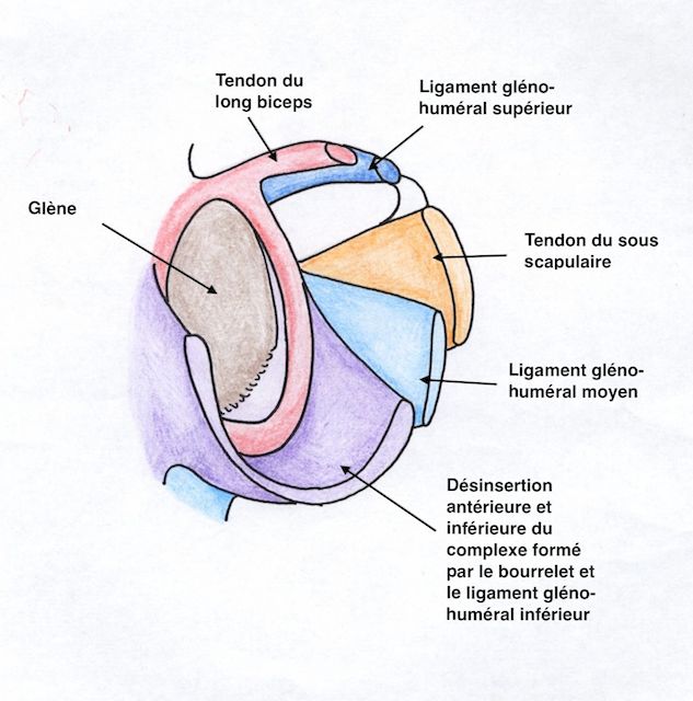 Lésion de Bankart ou arrachement du bourrelet antéro-inférieur 
                  et du ligament gléno-huméral inférieur