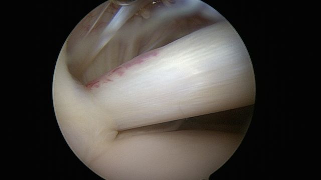biceps normal vu sous arthroscopie