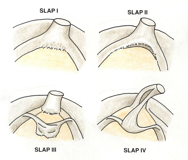 principaux types de lésions SLAP