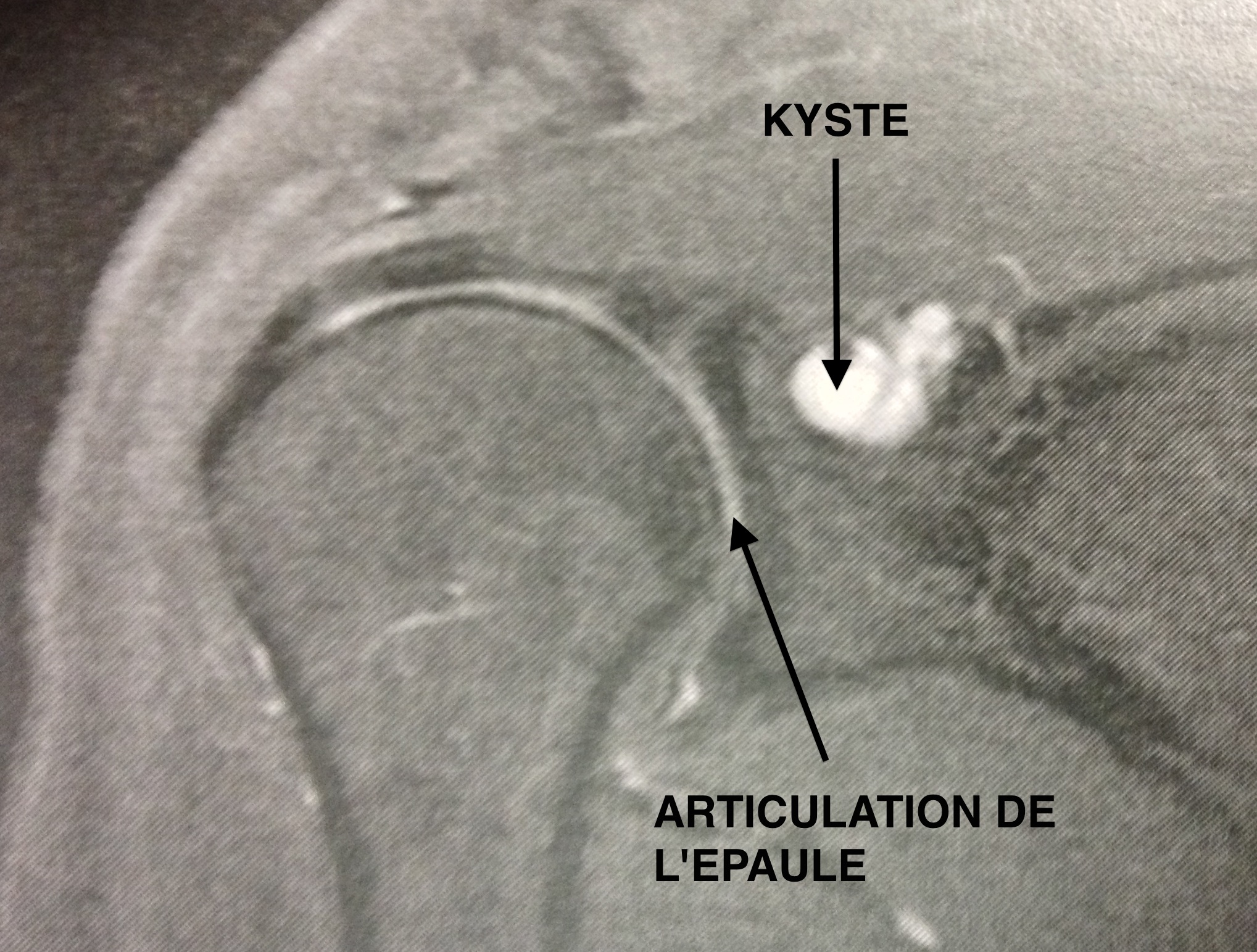 IRM montrant kyste comprimant le nerf supra-scapulaire