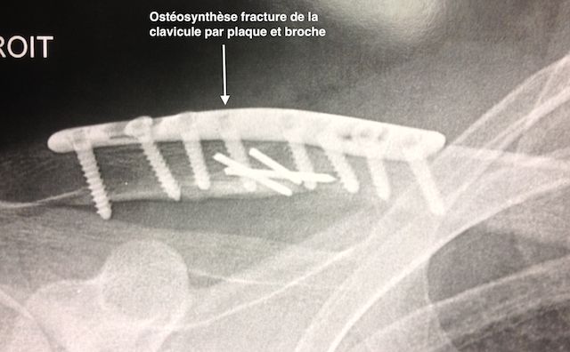 Ostéo-synthèse d'une fracture de la clavicule